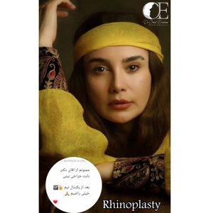 عمل بینی در تهران - دکتر ابراهیمی 