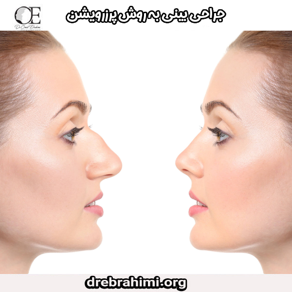 جراحی بینی به روش پرزرویشن - دکتر امید ابراهیمی https://drebrahimi.org/