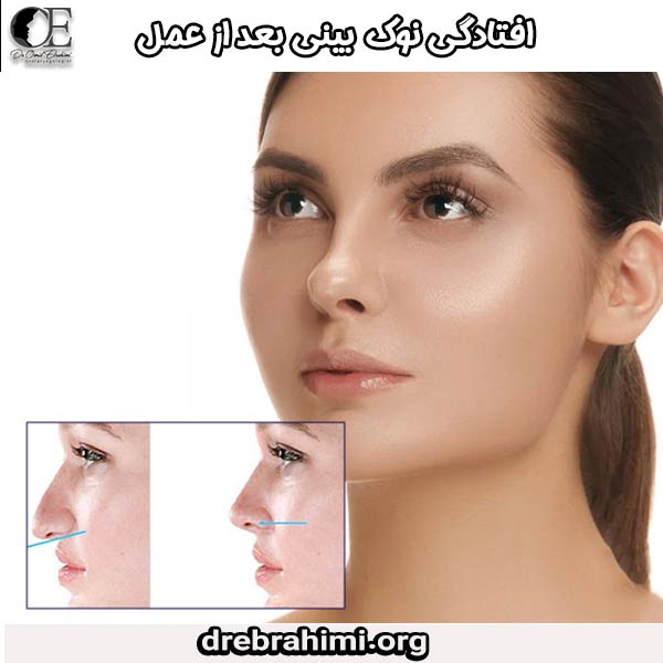 افتادگی نوک بینی بعد از عمل
