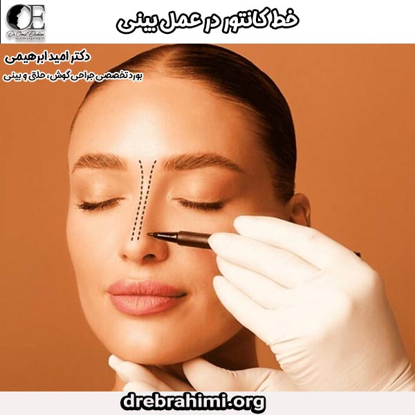 خط کانتور در عمل بینی - دکتر امید ابراهیمی