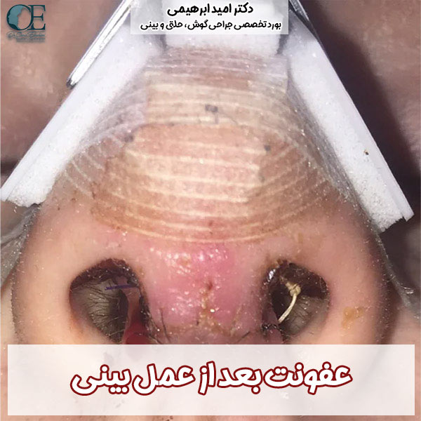 عفونت بعد از عمل بینی