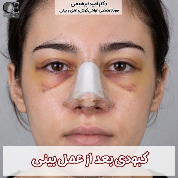 دلایل کبودی بعد از عمل بینی + زمان و مراحل کاهش کبودی های بعد عمل