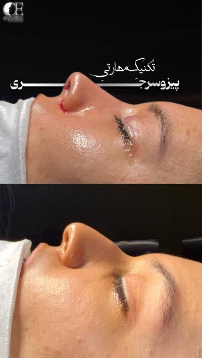 قبل و بعداز عمل بینی به روش پیزوسرجری