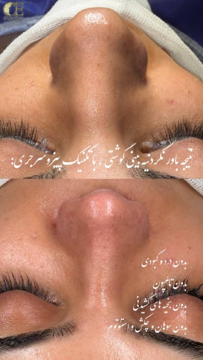 قبل و بعداز عمل بینی به روش پیزوسرجری