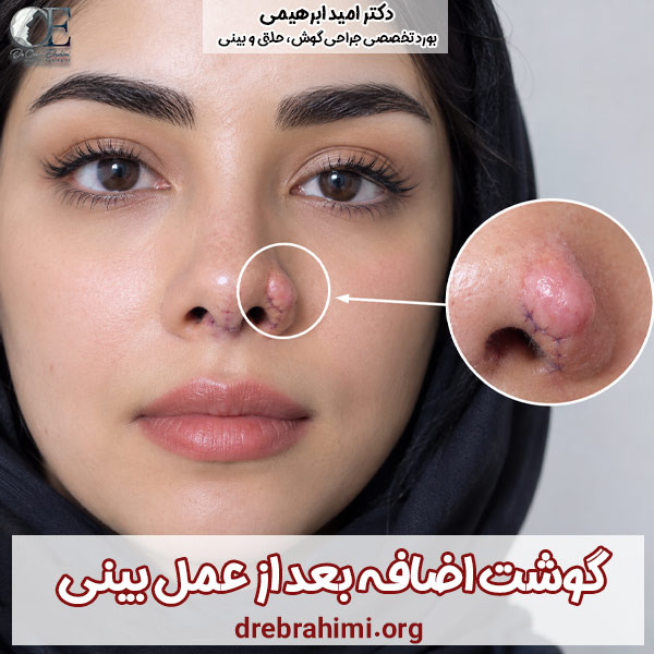 گوشت اضافه بعد از عمل بینی - دکتر امید ابراهیمی