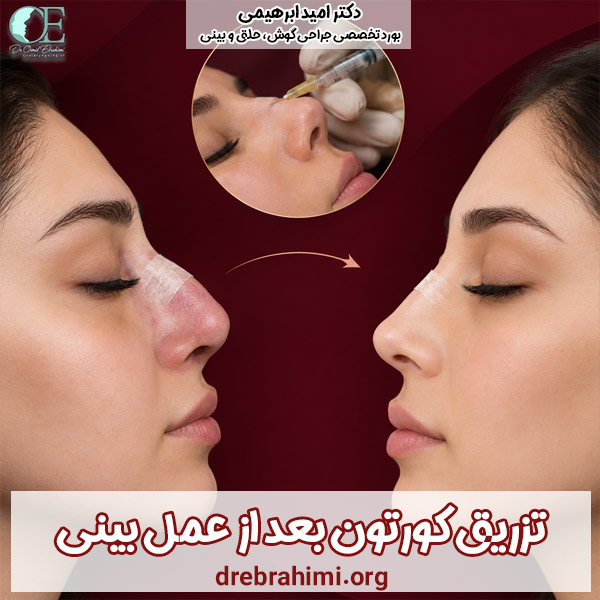 تزریق کورتون بعد از عمل بینی - دکتر امید ابراهیمی