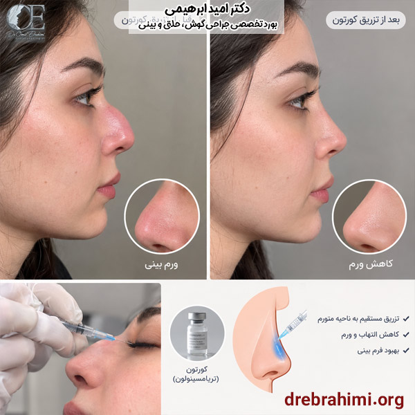 تزریق کورتون بعد از عمل بینی - دکتر امید ابراهیمی