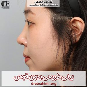 جراحی بینی طبیعی - دکتر ابراهیمی