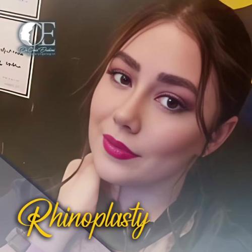 rhinoplasty.jpg288