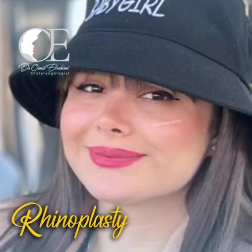 rhinoplasty.jpg290