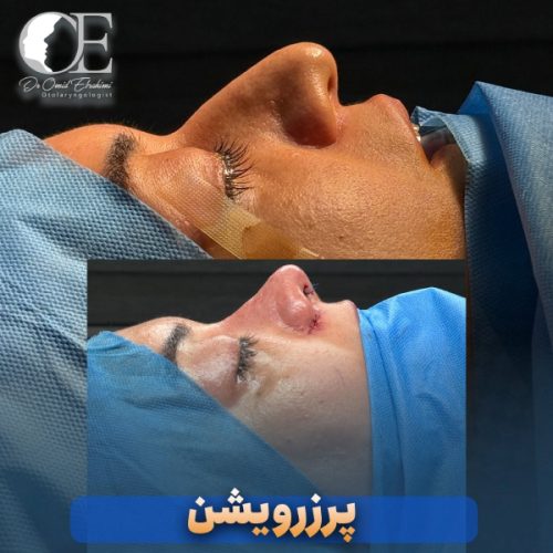 rhinoplasty.jpg293
