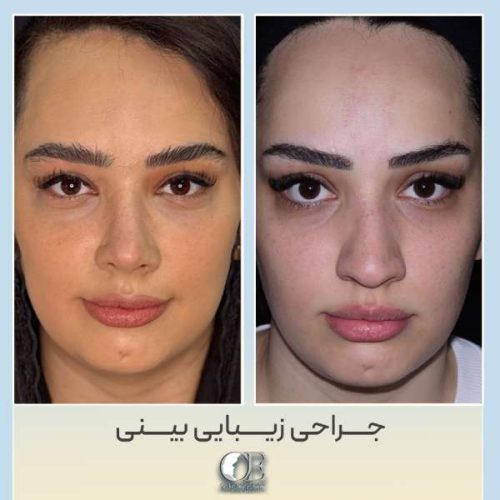 rhinoplasty318