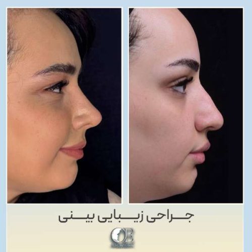 rhinoplasty319