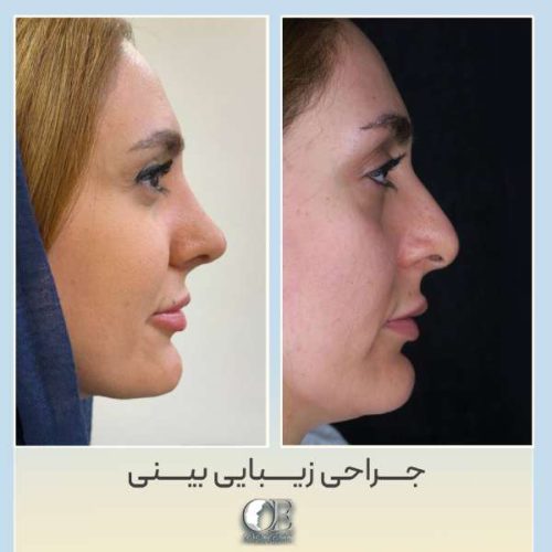 rhinoplasty320