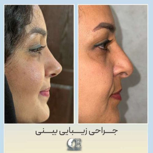 rhinoplasty321