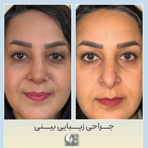 rhinoplasty322
