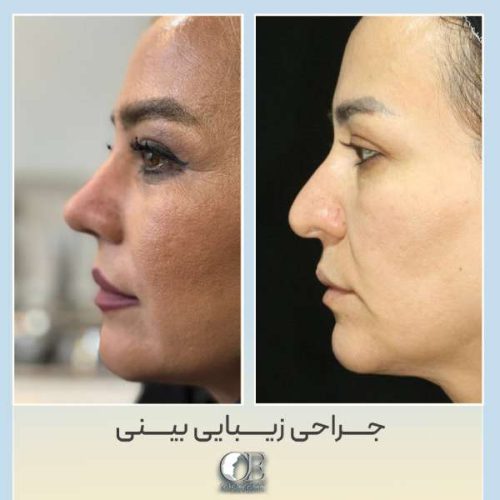 rhinoplasty323