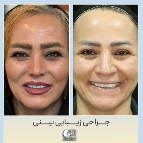 rhinoplasty324