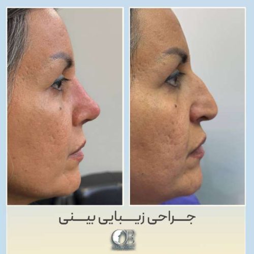 rhinoplasty325