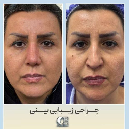 rhinoplasty326