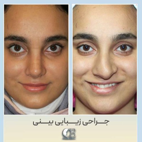 rhinoplasty327