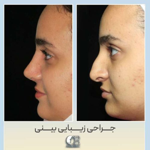 rhinoplasty328