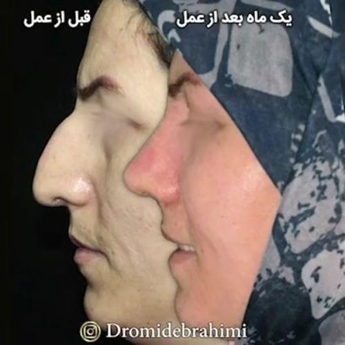 thin-skin-nose-job-139