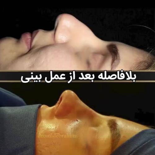 thin-skin-nose-job-140