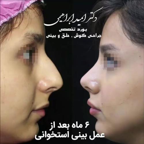 thin-skin-nose-job-144