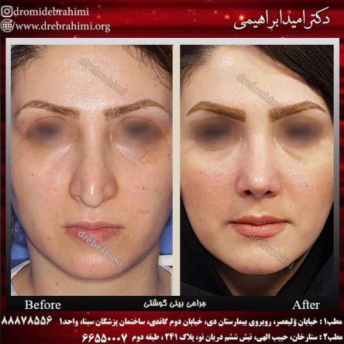 عمل-بینی-گوشتی-21