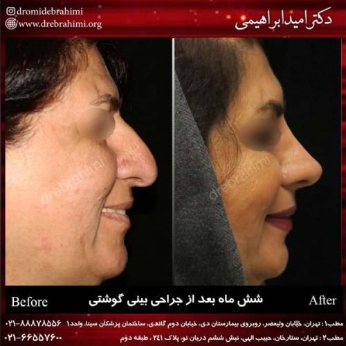 عمل بینی گوشتی 122