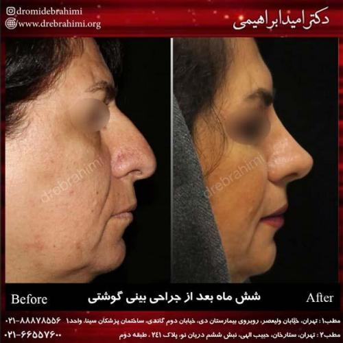 عمل بینی گوشتی 123