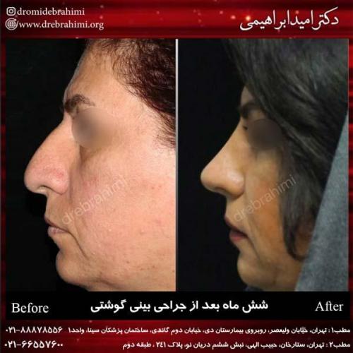 عمل بینی گوشتی 124