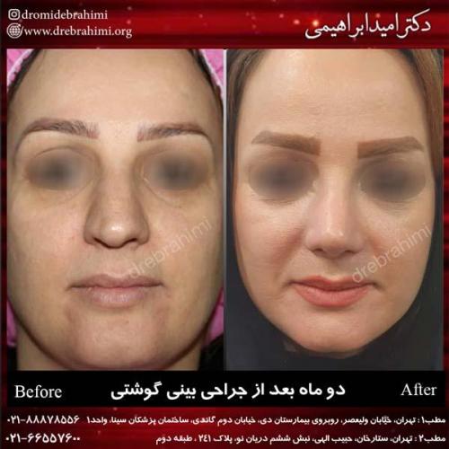 عمل بینی گوشتی 125