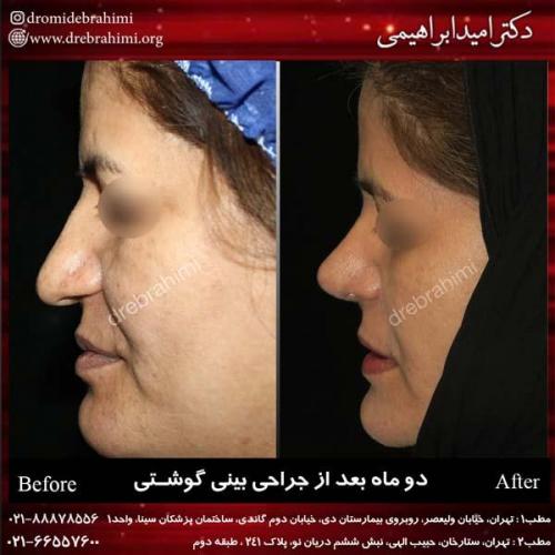 عمل بینی گوشتی 142
