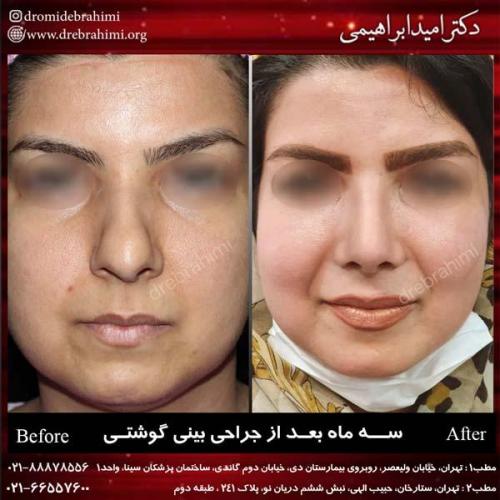 عمل بینی گوشتی 143