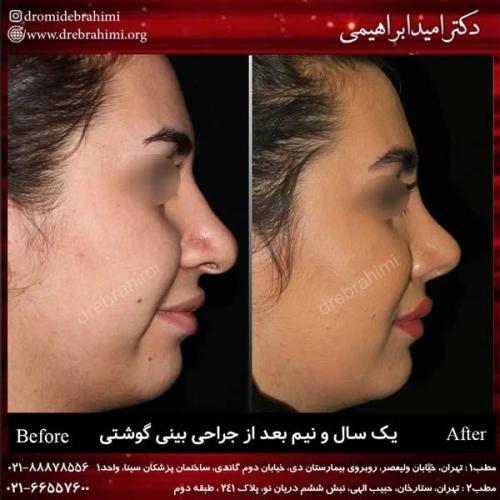 عمل بینی گوشتی 150