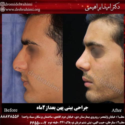 عمل بینی گوشتی 53