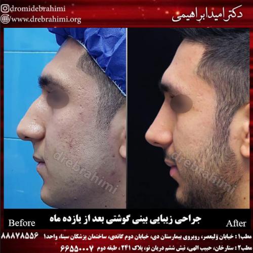 عمل بینی گوشتی 61