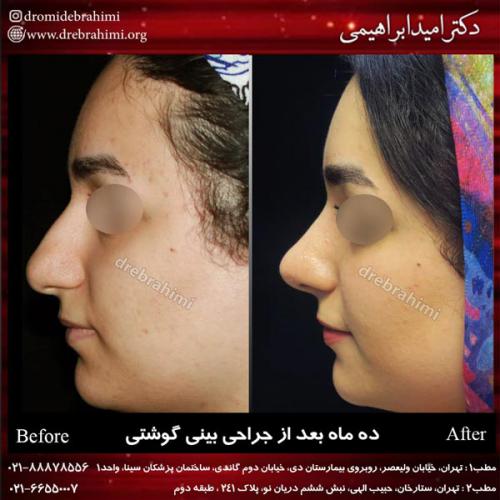 عمل بینی گوشتی 80