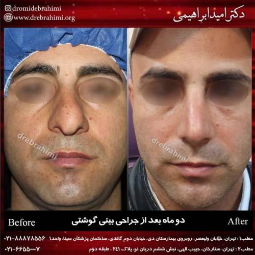 عمل بینی گوشتی 97