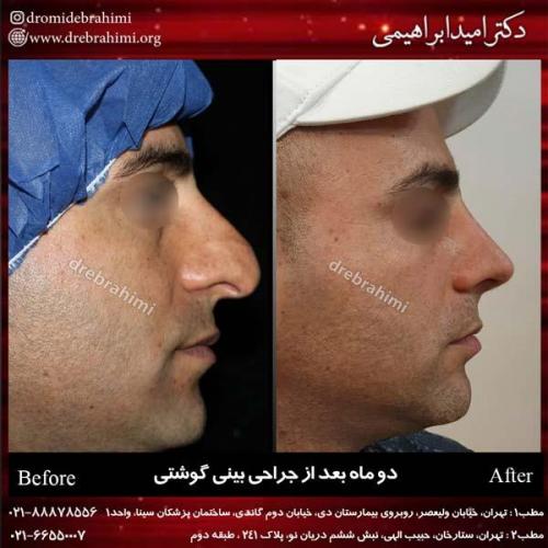 عمل بینی گوشتی 98