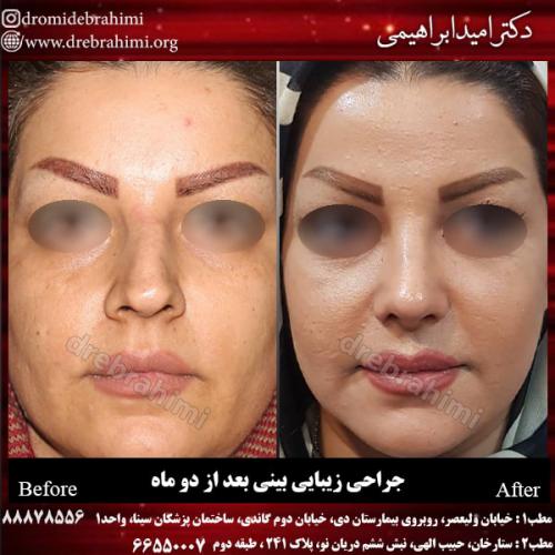 جراحی بینی 117