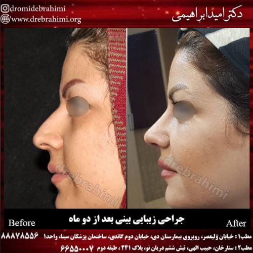 جراحی بینی 120