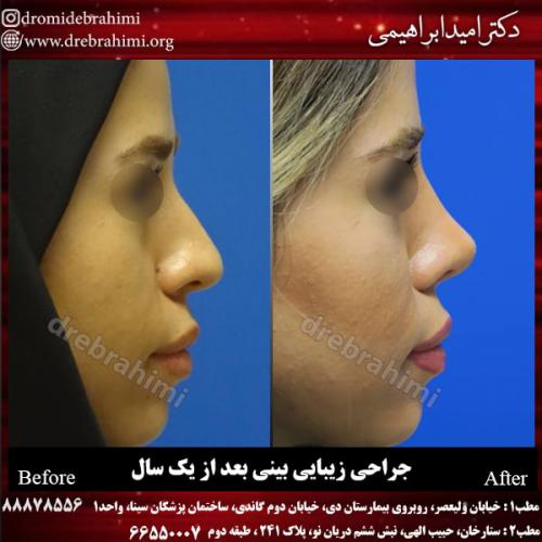 جراحی بینی 121