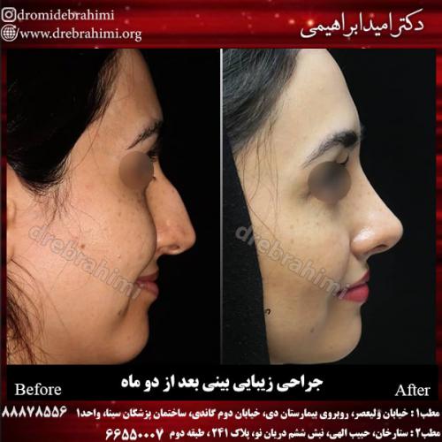 جراحی بینی 127