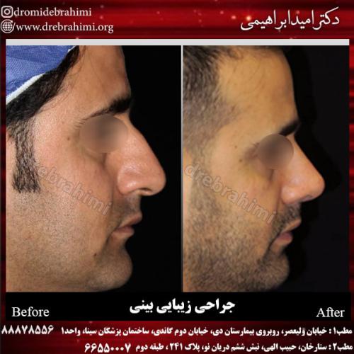 جراحی بینی 138