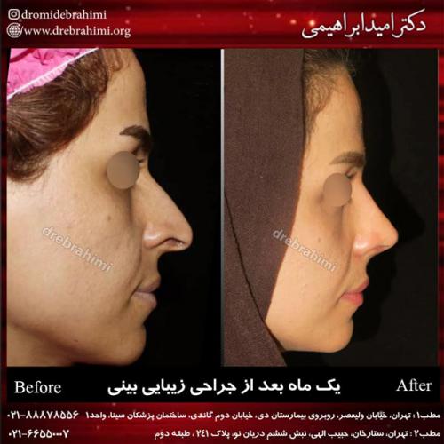 جراحی بینی 139
