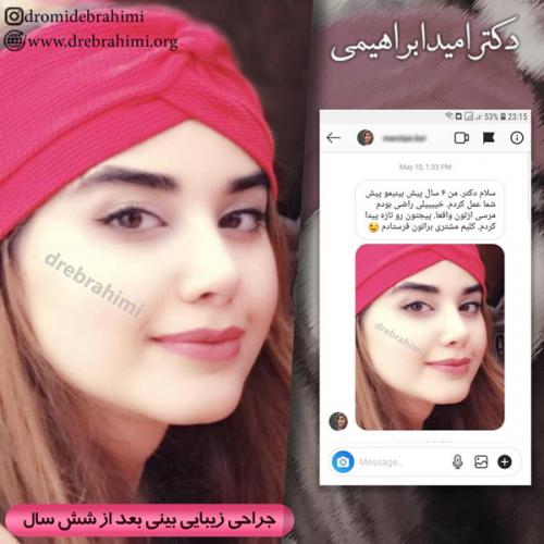 جراحی بینی 140
