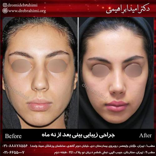 جراحی بینی 143